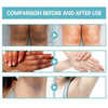 Acanthosis Nigricans Therapy Cream