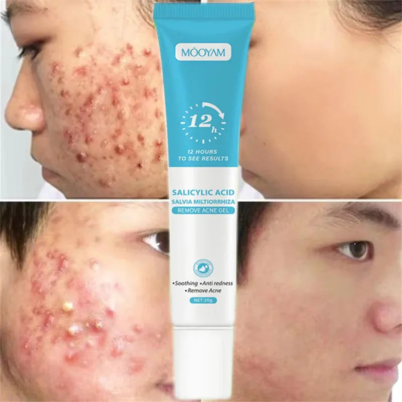 Anti-Acne Cream with Salicylic Acid – Clear Skin & Pore Refining