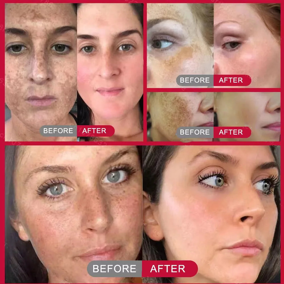 Whitening Freckle Cream – Dark Spot Corrector