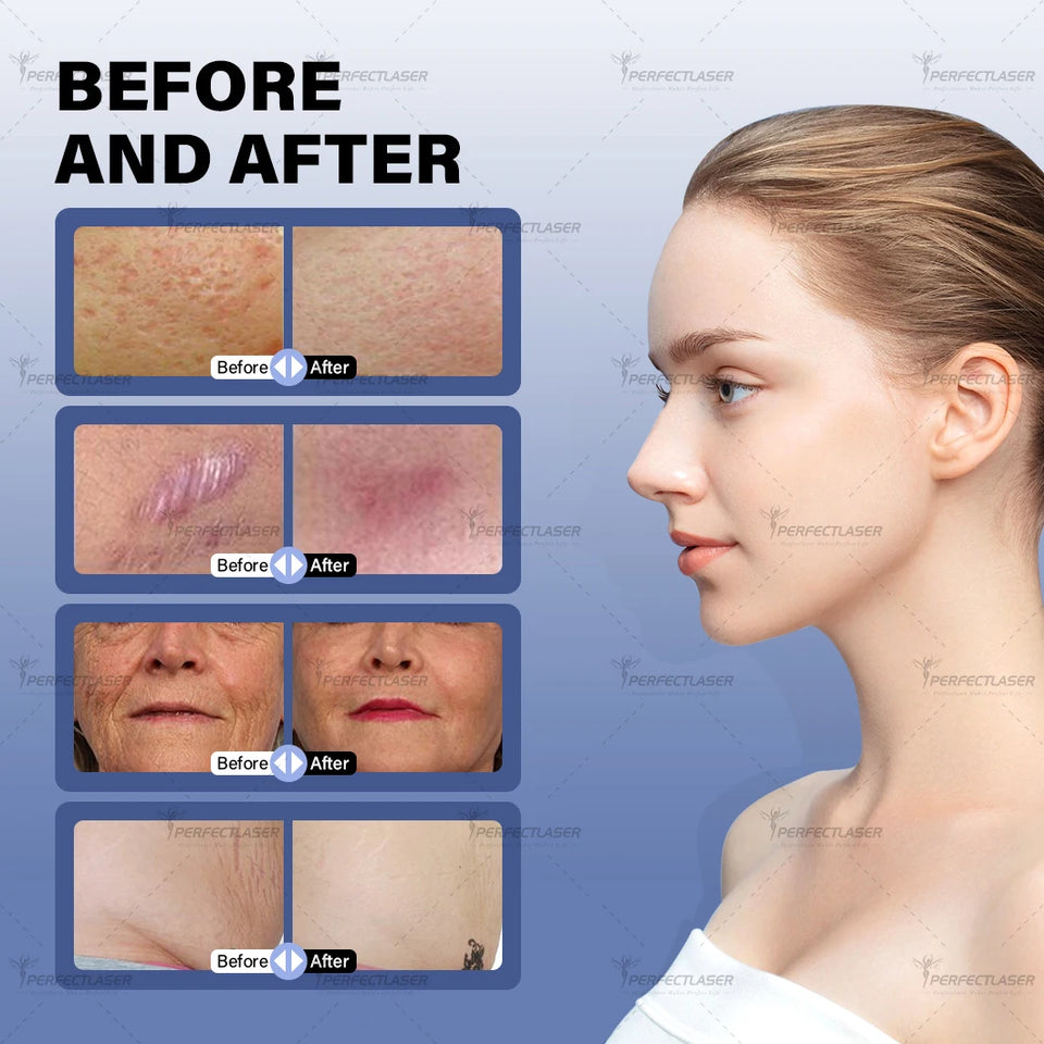Portable CO2 Fractional Laser Machine 60W – Skin Tightening & Scar Removal