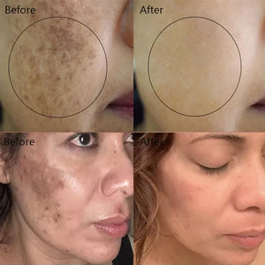 Dark Spot Remover & Whitening Face Cream – Vitamin C Brightening