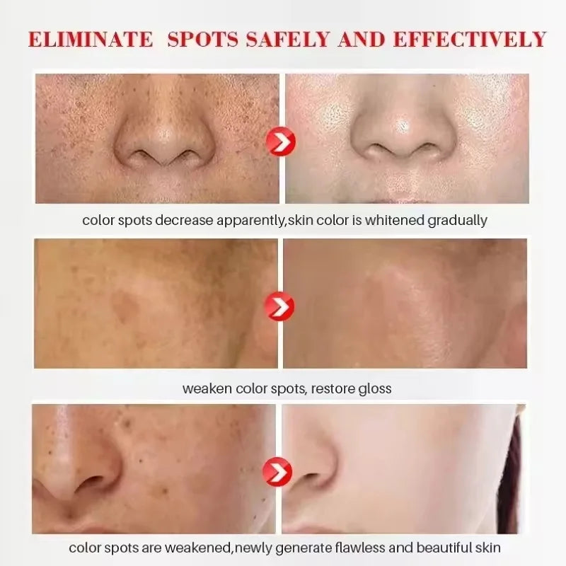 Brightening Freckle Removal Face Serum – Whitening & Hydrating