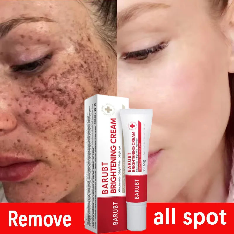 Whitening Freckle Cream – Dark Spot Corrector