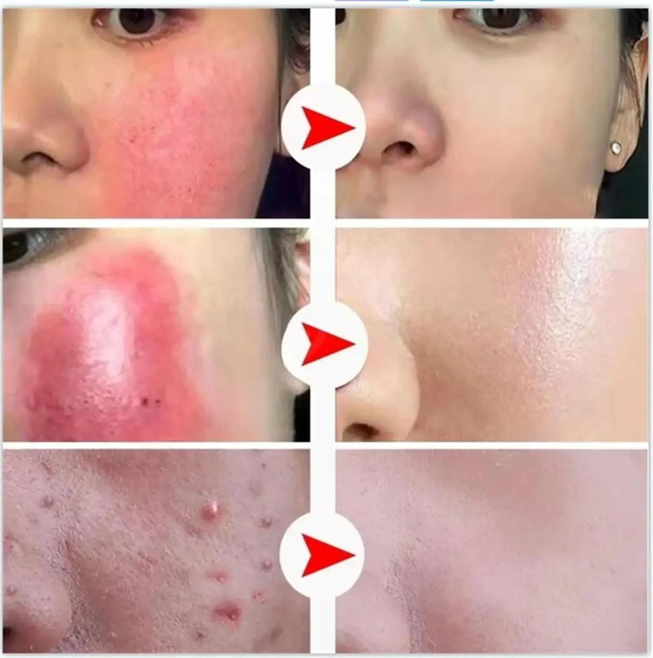 B5 Facial Redness Repair Cream for Sensitive & Acne-Prone Skin – Hydrating & Calming