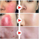 B5 Facial Redness Repair Cream for Sensitive & Acne-Prone Skin – Hydrating & Calming