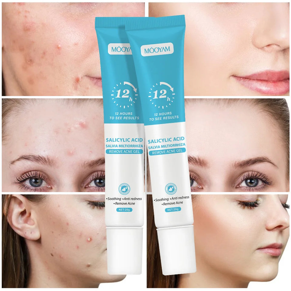 Anti-Acne Cream with Salicylic Acid – Clear Skin & Pore Refining