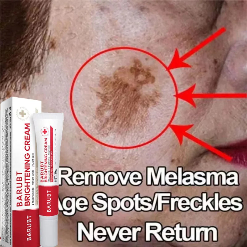 Whitening Freckle Cream – Dark Spot Corrector