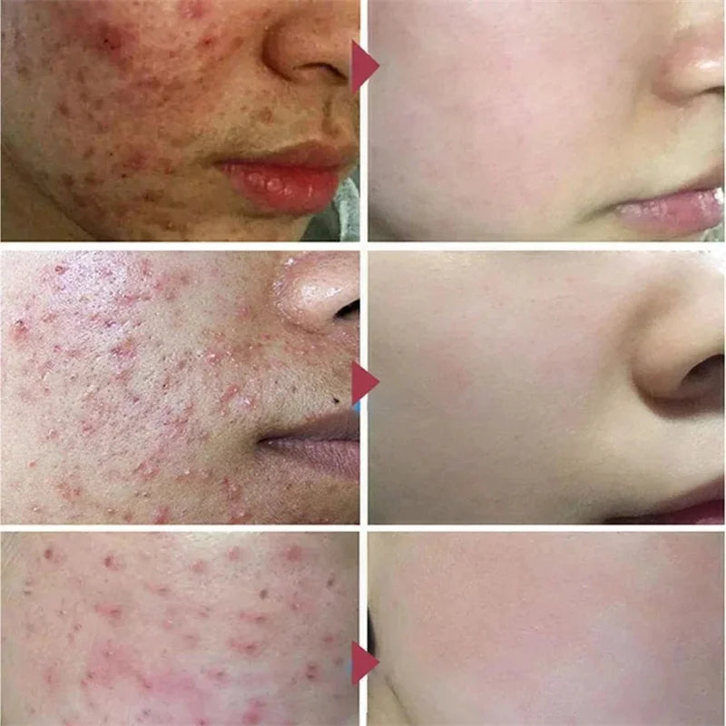 Salicylic Acid Acne Treatment Cream – Anti-Pimple & Oil Control