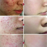 Salicylic Acid Acne Treatment Cream – Anti-Pimple & Oil Control