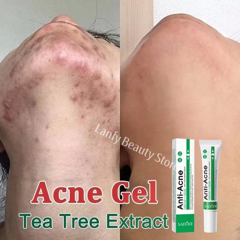 Salicylic Acid Acne Treatment Cream – Anti-Pimple & Oil Control