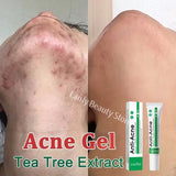 Salicylic Acid Acne Treatment Cream – Anti-Pimple & Oil Control