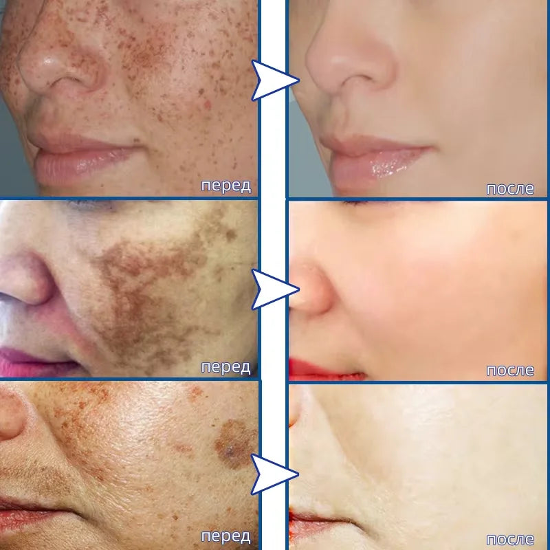 Whitening Freckle Cream – Dark Spot Corrector