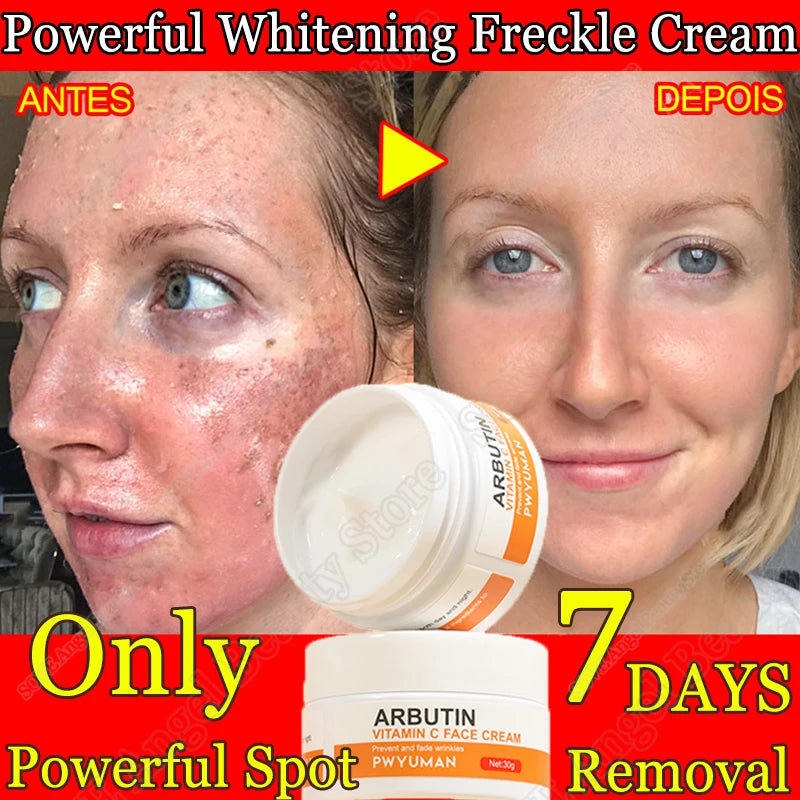 Dark Spot Remover & Whitening Face Cream – Vitamin C Brightening