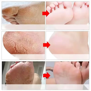 Cracked Heel Repair Foot Cream Spray – Exfoliating & Moisturizing 100ml