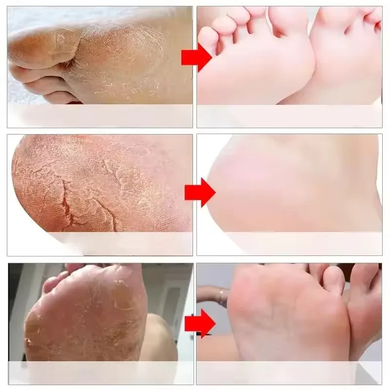 Cracked Heel Repair Foot Cream Spray – Exfoliating & Moisturizing 100ml