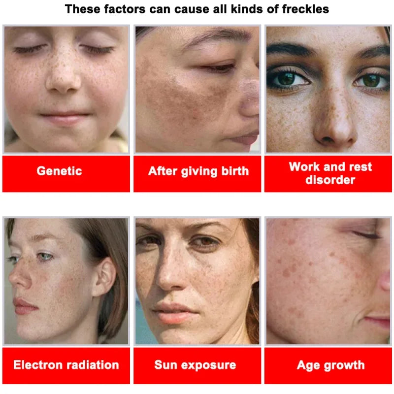 Whitening Freckle Cream – Dark Spot Corrector