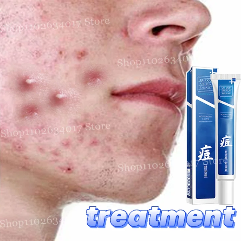 Acne Removal & Brightening Face Cream – Anti-Aging & Whitening