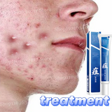 Acne Removal & Brightening Face Cream – Anti-Aging & Whitening