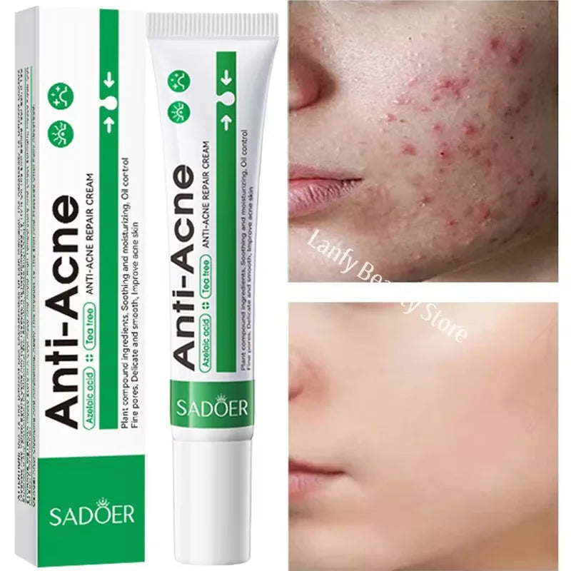 Salicylic Acid Acne Treatment Cream – Anti-Pimple & Oil Control