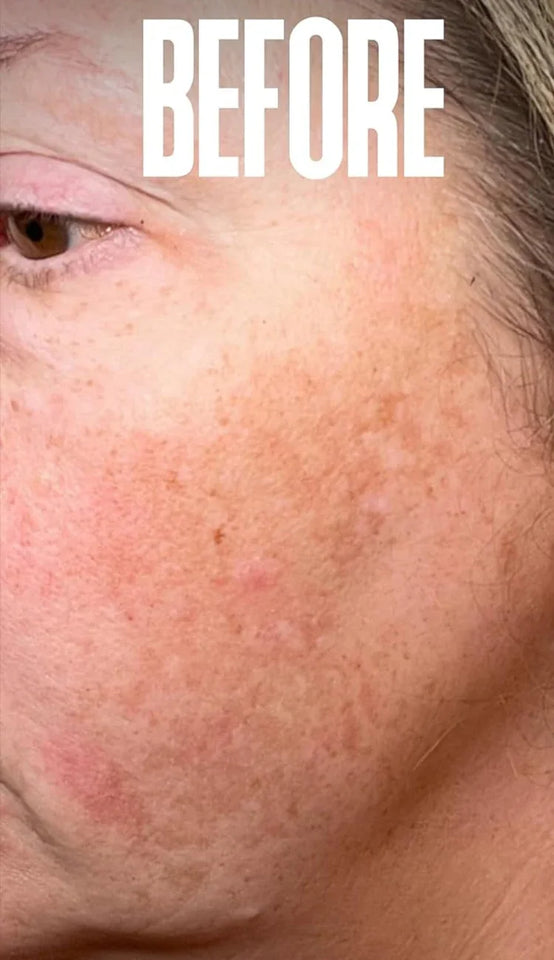 Dark Spot Remover & Freckle Whitening Serum