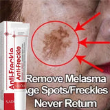Niacinamide Dark Spot Correcting Cream – Brightening & Freckle Removal 20g