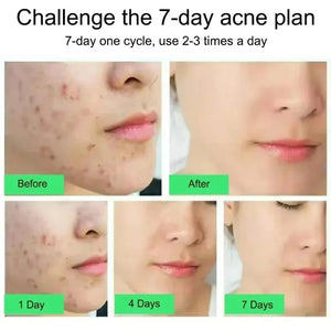 Anti-Acne Cream with Salicylic Acid – Clear Skin & Pore Refining