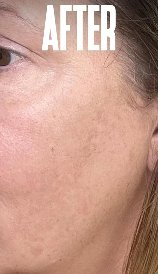 Dark Spot Remover & Freckle Whitening Serum