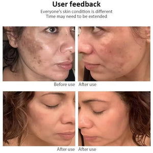 Niacinamide Dark Spot Correcting Cream – Brightening & Freckle Removal 20g
