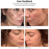 Niacinamide Dark Spot Correcting Cream – Brightening & Freckle Removal 20g