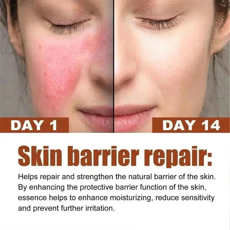 B5 Facial Redness Repair Cream for Sensitive & Acne-Prone Skin – Hydrating & Calming