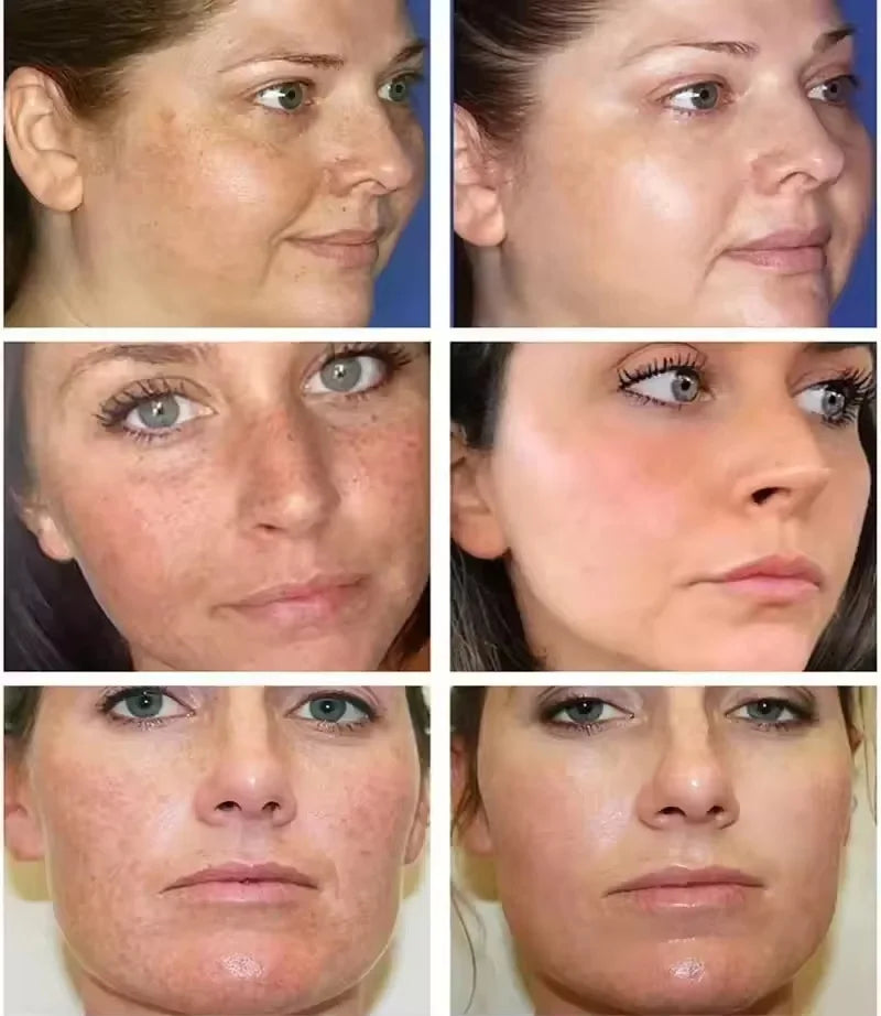 Brightening Freckle Removal Face Serum – Whitening & Hydrating