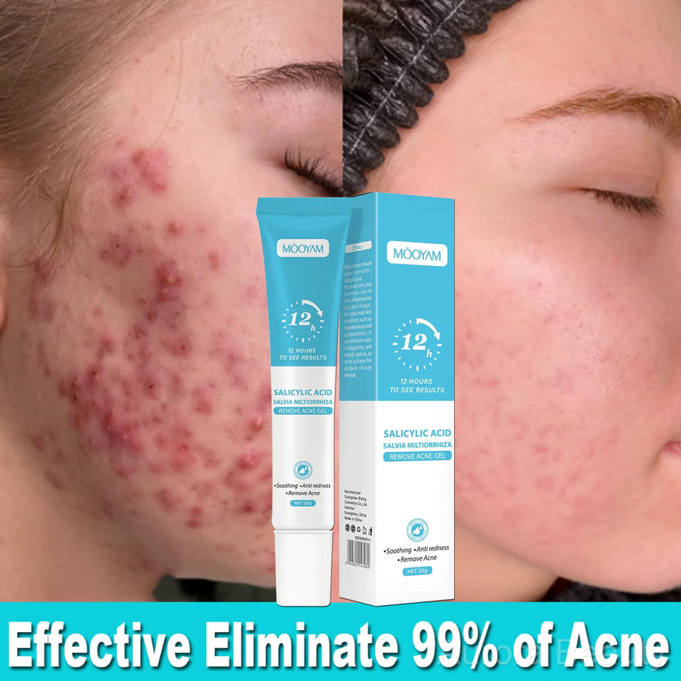 Anti-Acne Cream with Salicylic Acid – Clear Skin & Pore Refining