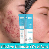 Anti-Acne Cream with Salicylic Acid – Clear Skin & Pore Refining