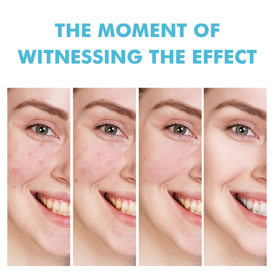 Anti-Acne Cream with Salicylic Acid – Clear Skin & Pore Refining