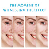 Anti-Acne Cream with Salicylic Acid – Clear Skin & Pore Refining