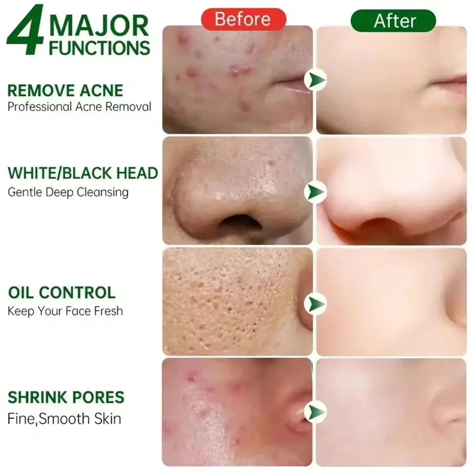 B5 Facial Redness Repair Cream for Sensitive & Acne-Prone Skin – Hydrating & Calming