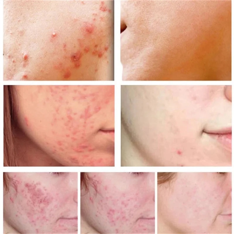 Salicylic Acid Acne Treatment Cream – Anti-Pimple & Oil Control