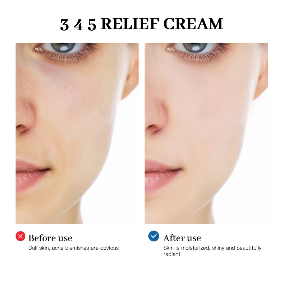 345 Relief Cream – Acne, Freckle & Oil Control Face Moisturizer
