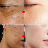 Astragalus Freckle Cream – Dark Spot Remover & Brightening (55g)