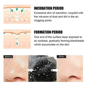 Blackhead Removal Nose Strips – Deep Cleansing & Pore Refining