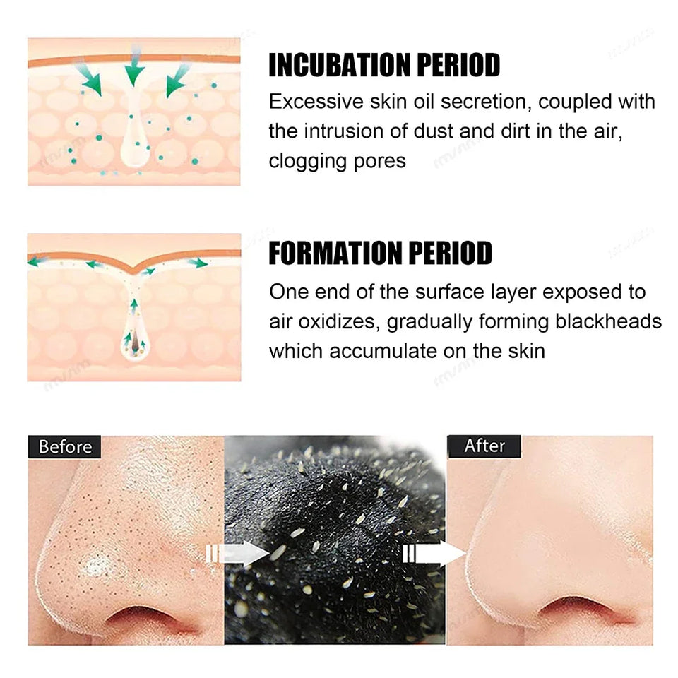 Blackhead Removal Nose Strips – Deep Cleansing & Pore Refining