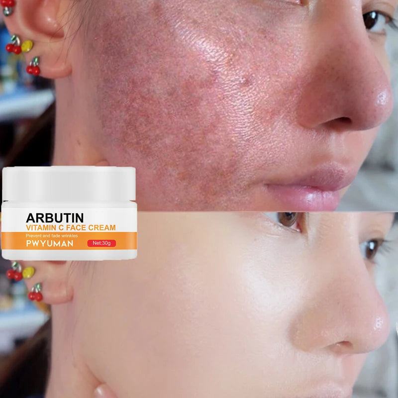Dark Spot Remover & Whitening Face Cream – Vitamin C Brightening